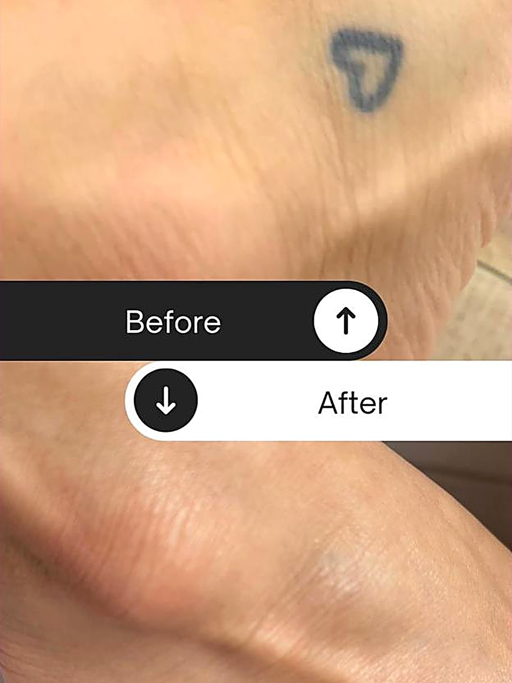 Antes y después: remoción de tatuaje en la muñeca