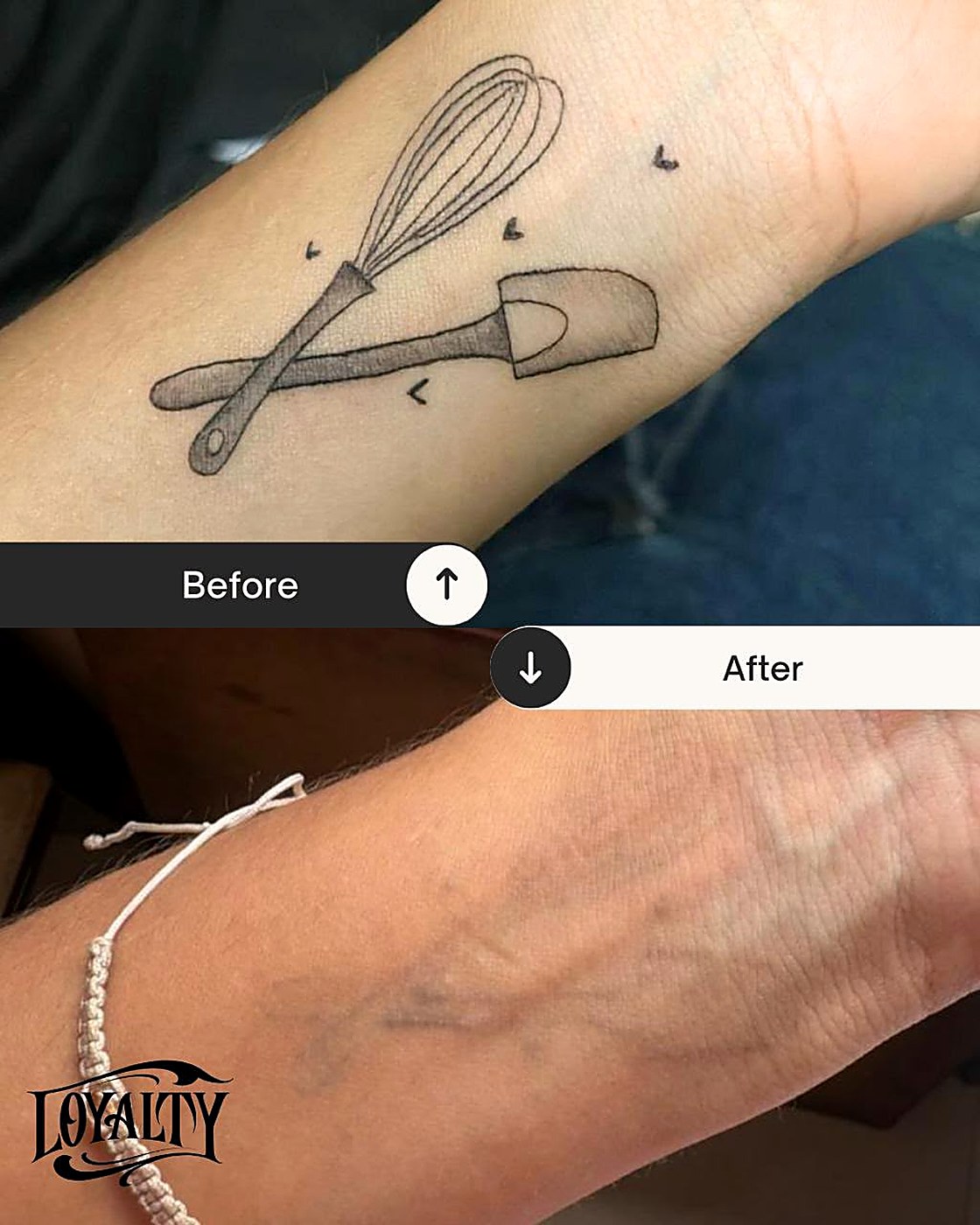 Antes y después: remoción de tatuaje en la muñeca