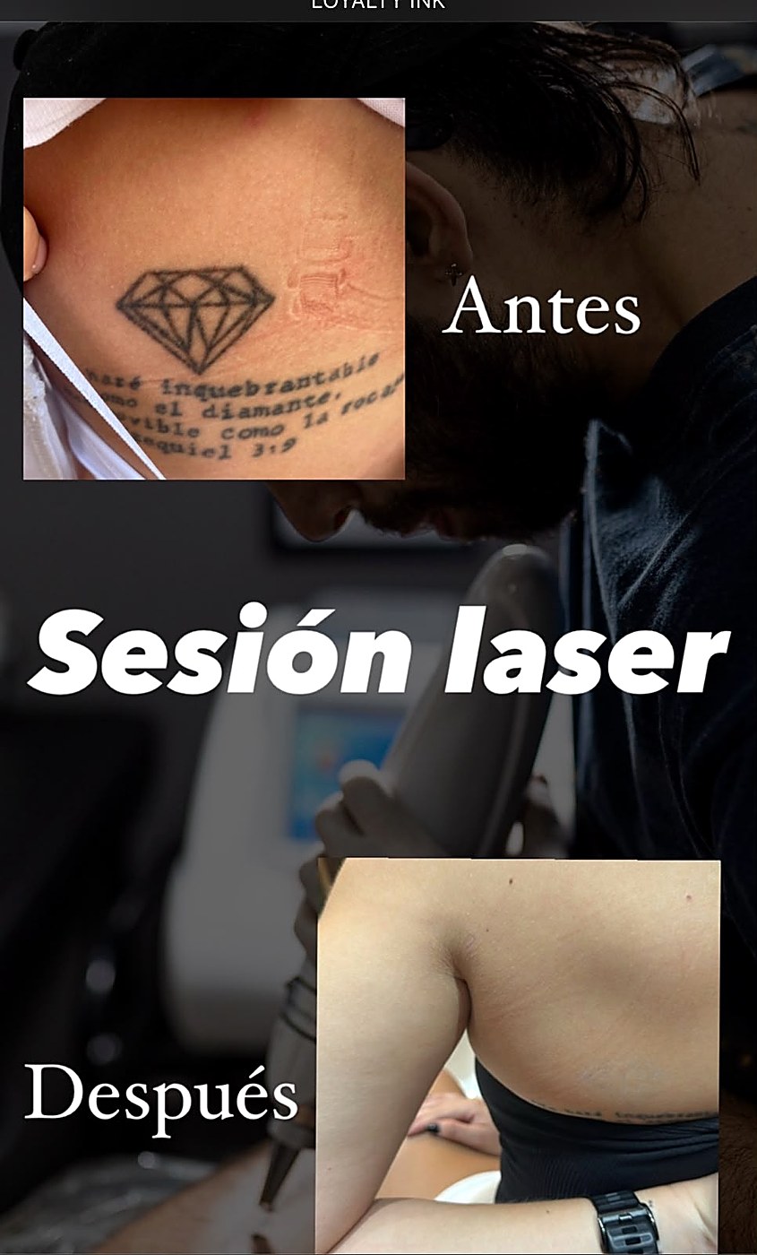 Antes y después: sesión láser de remoción